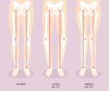 Hallux valgus