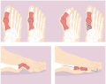 Hallux valgus